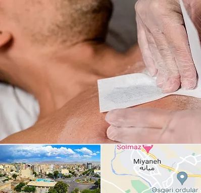 اپیلاسیون آقایان در میانه