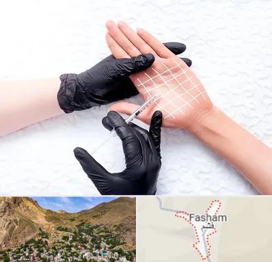 تزریق بوتاکس کف دست در فشم