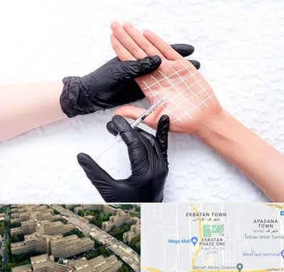 تزریق بوتاکس کف دست در اکباتان 