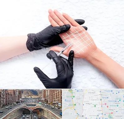 تزریق بوتاکس کف دست در منطقه 10 تهران 