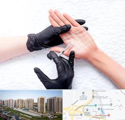 تزریق بوتاکس کف دست در المپیک 