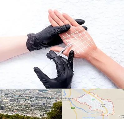 تزریق بوتاکس کف دست در یاسوج