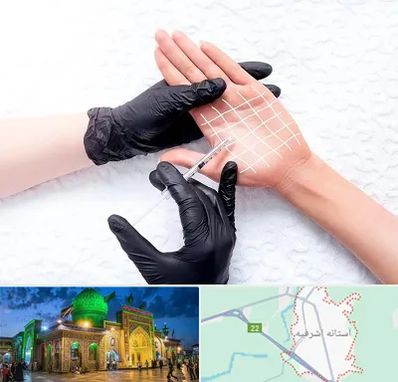 تزریق بوتاکس کف دست در آستانه اشرفیه