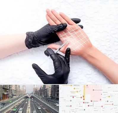 تزریق بوتاکس کف دست در توحید 