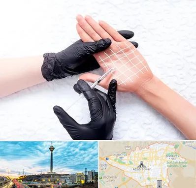 تزریق بوتاکس کف دست در تهران