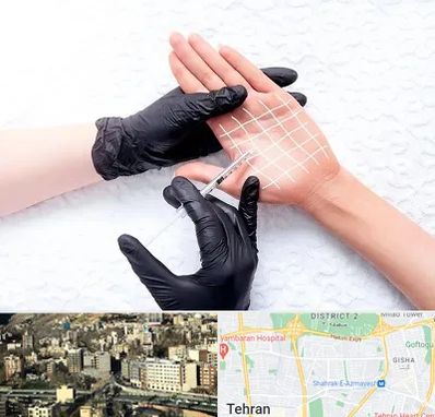 تزریق بوتاکس کف دست در مرزداران 