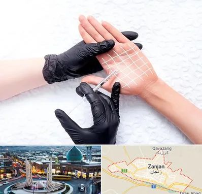 تزریق بوتاکس کف دست در زنجان