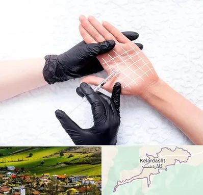 تزریق بوتاکس کف دست در کلاردشت