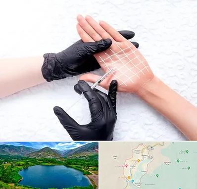 تزریق بوتاکس کف دست در رودبار