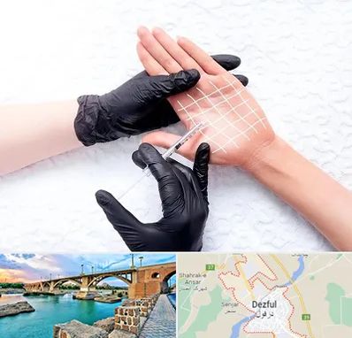 تزریق بوتاکس کف دست در دزفول