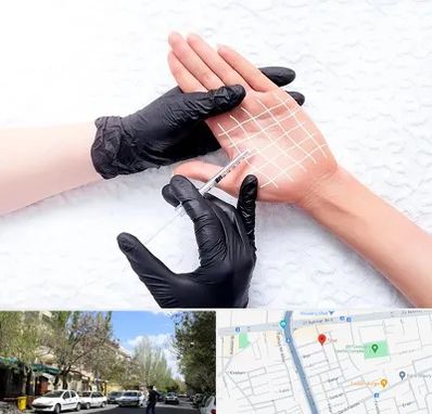 تزریق بوتاکس کف دست در کوی فیروز تبریز