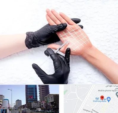 تزریق بوتاکس کف دست در چهارراه طالقانی کرج