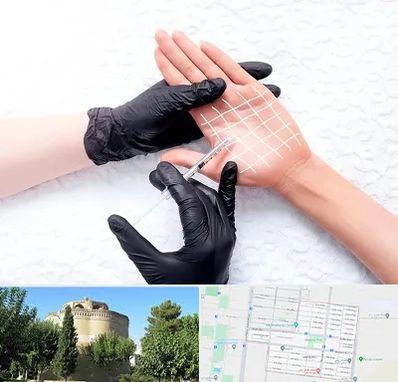 تزریق بوتاکس کف دست در مرداویج اصفهان