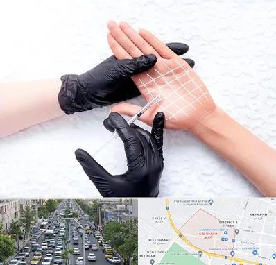 تزریق بوتاکس کف دست در گلشهر کرج
