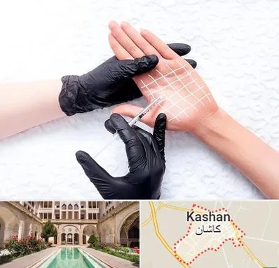 تزریق بوتاکس کف دست در کاشان