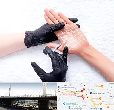 تزریق بوتاکس کف دست در پارک وی 