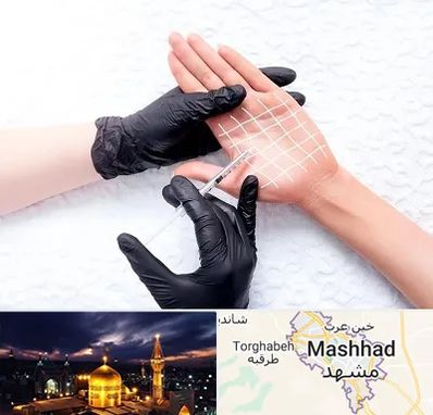 تزریق بوتاکس کف دست در مشهد