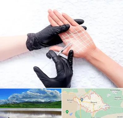 تزریق بوتاکس کف دست در مرند