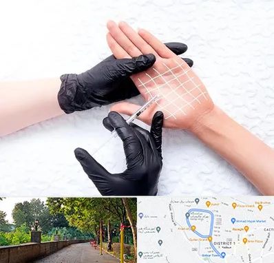 تزریق بوتاکس کف دست در بلوار گیلان رشت