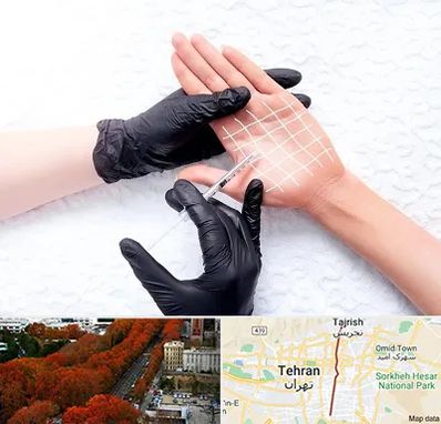 تزریق بوتاکس کف دست در ولیعصر 