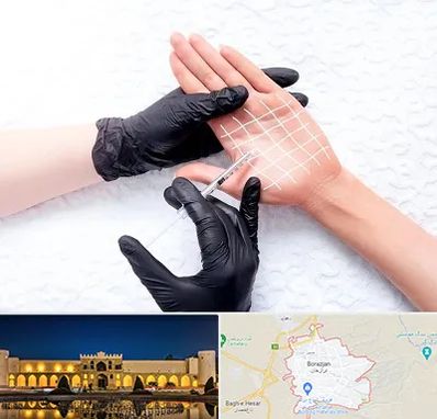 تزریق بوتاکس کف دست در برازجان