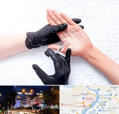 تزریق بوتاکس کف دست در کیانپارس اهواز