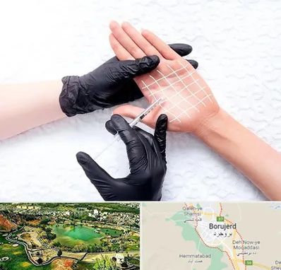 تزریق بوتاکس کف دست در بروجرد