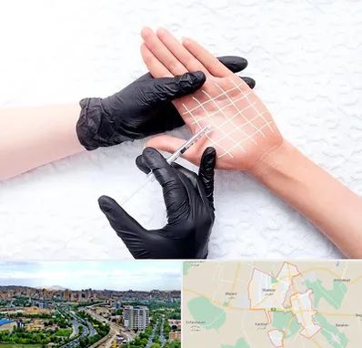 تزریق بوتاکس کف دست در شهریار