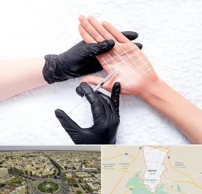 تزریق بوتاکس کف دست در قزوین