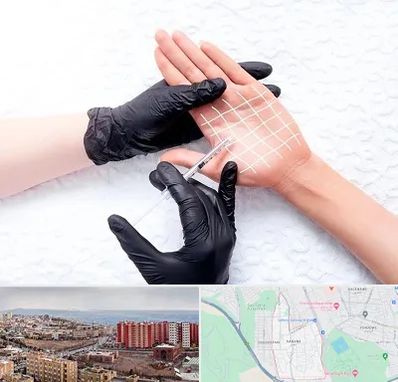 تزریق بوتاکس کف دست در سهند تبریز