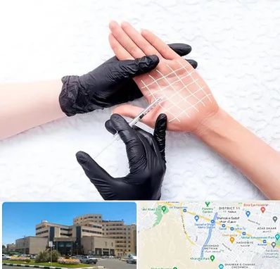 تزریق بوتاکس کف دست در صیاد شیرازی مشهد