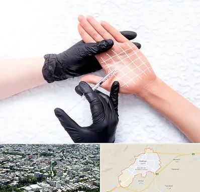 تزریق بوتاکس کف دست در شاهرود