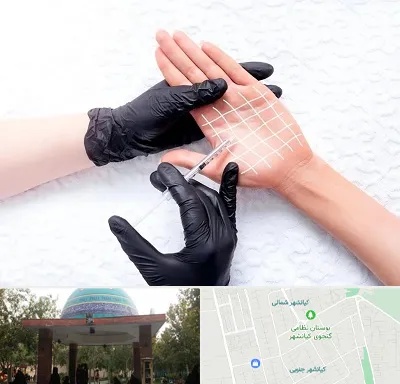 تزریق بوتاکس کف دست در کیانشهر