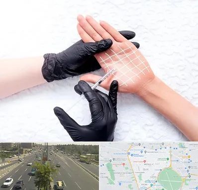 تزریق بوتاکس کف دست در منطقه 17 تهران 