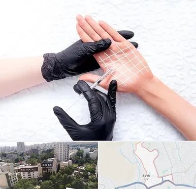 تزریق بوتاکس کف دست در اوین