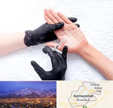 تزریق بوتاکس کف دست در کرمانشاه