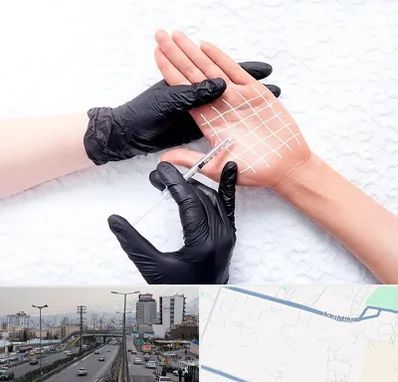 تزریق بوتاکس کف دست در بلوار ارتش