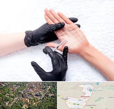 تزریق بوتاکس کف دست در دماوند