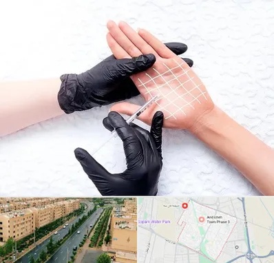 تزریق بوتاکس کف دست در فاز سه اندیشه