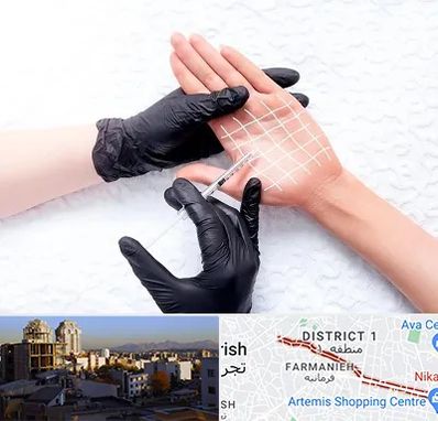 تزریق بوتاکس کف دست در فرمانیه 