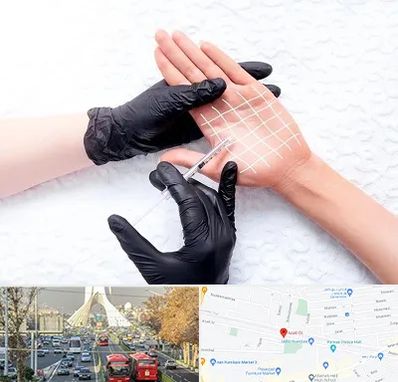 تزریق بوتاکس کف دست در خیابان آزادی 