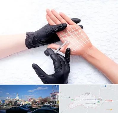 تزریق بوتاکس کف دست در ماهدشت کرج