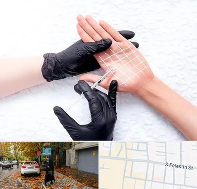 تزریق بوتاکس کف دست در خیابان فلسطین