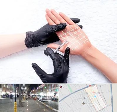 تزریق بوتاکس کف دست در باغ فیض اسلامشهر