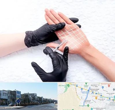 تزریق بوتاکس کف دست در شریعتی مشهد