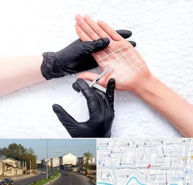 تزریق بوتاکس کف دست در ضیابری رشت