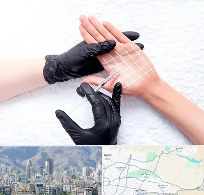 تزریق بوتاکس کف دست در شمال شرق تهران