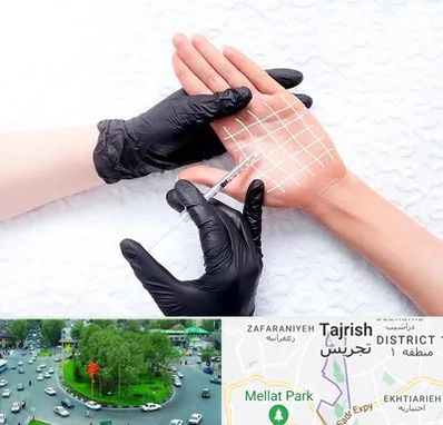 تزریق بوتاکس کف دست در تجریش 