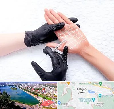 تزریق بوتاکس کف دست در لاهیجان