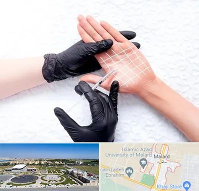 تزریق بوتاکس کف دست در ملارد